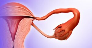 Scopri di più sull'articolo Endometriosi extrapelvica: la migrazione sistemica delle cellule endometriali