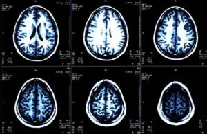 Scopri di più sull'articolo Covid19: effetti sul cervello, 300 studi mettono in allarme