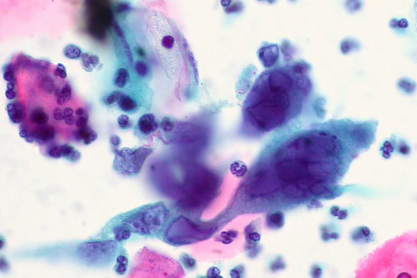 Al momento stai visualizzando Herpes virus ‘alleato’ contro il cancro, uccide le cellule tumorali