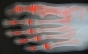Scopri di più sull'articolo Ixekizumab per l’artrite psoriasica: sicurezza, efficacia e selezione del paziente
