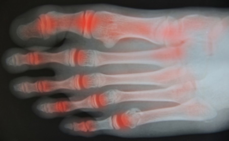 Al momento stai visualizzando Ixekizumab per l’artrite psoriasica: sicurezza, efficacia e selezione del paziente