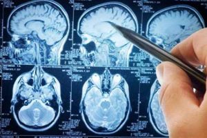 Scopri di più sull'articolo Sclerosi multipla: nuova cura con cellule staminali nel cervello